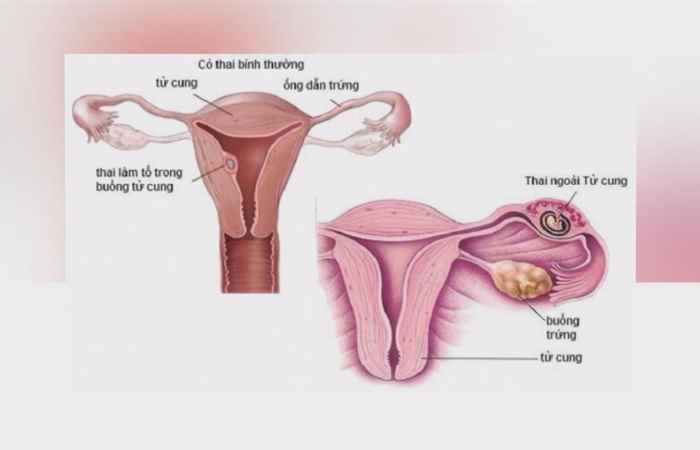 Sống khỏe 360 -  Dính buồng tử cung - Nguyên nhân gây vô sinh nữ (25-02-2020)